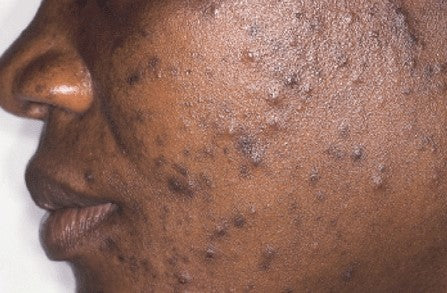 I Changed The Way I Think About My Hyperpigmentation, Thanks To This Expert Advice